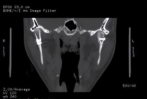 “下巴”外伤莫大意，警惕花式髁突骨折