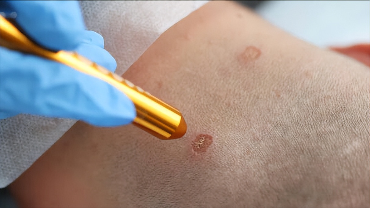 痣变大会是癌变吗,痣变大就是癌变了吗