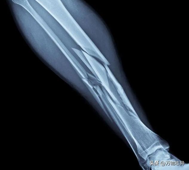 婆婆意外摔倒导致大腿骨骨折,婆婆腿骨折受罪了