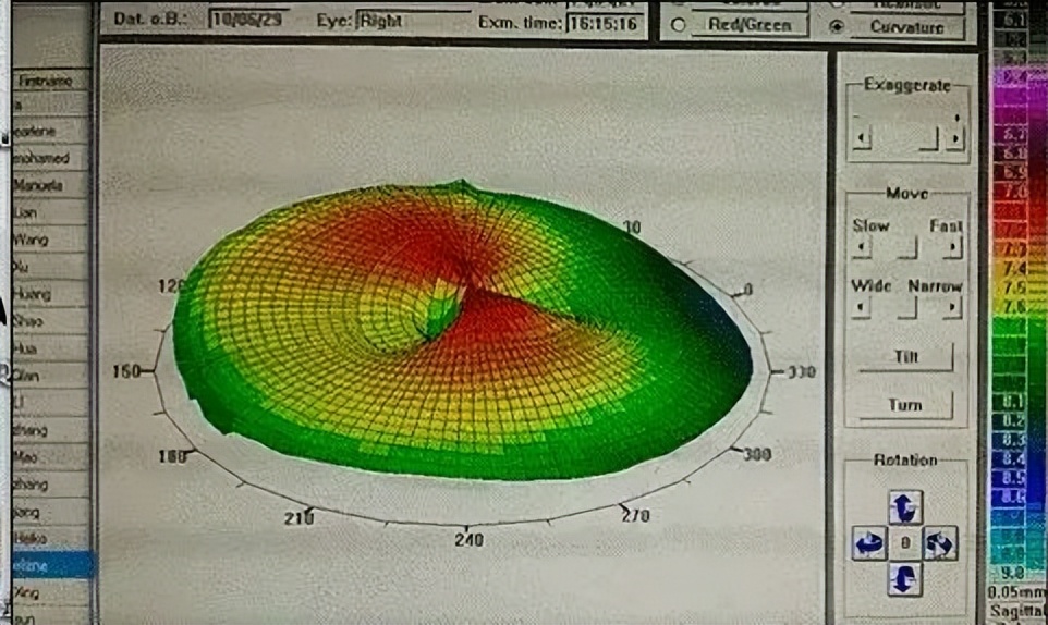 佩戴ok镜老是眨眼怎么办,戴ok镜时一只眼睛有刺痛感