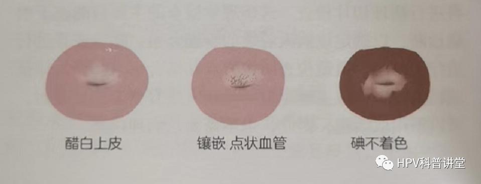 派特灵洁尔,派特灵和派特舒尔区别