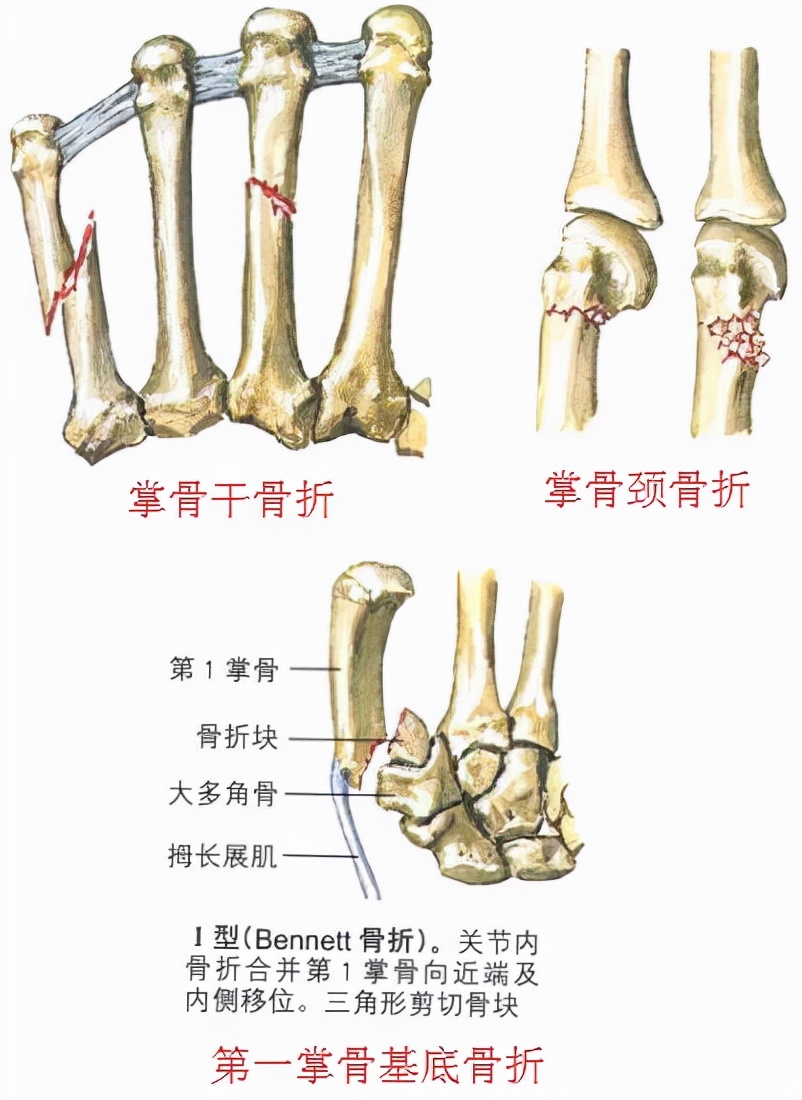 手掌骨折保守治疗和手术的优劣,手指骨折是手术还是保守治疗