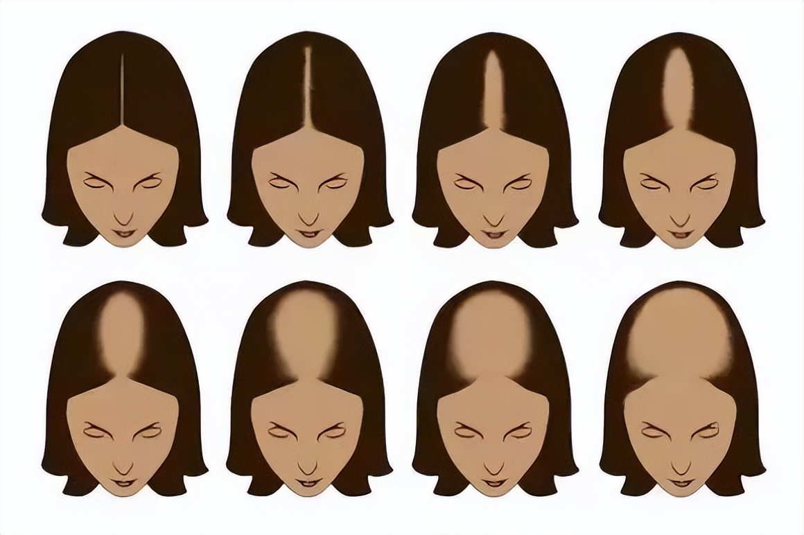 脱发脱得严重用什么防脱发,防脱要趁早改善脱发