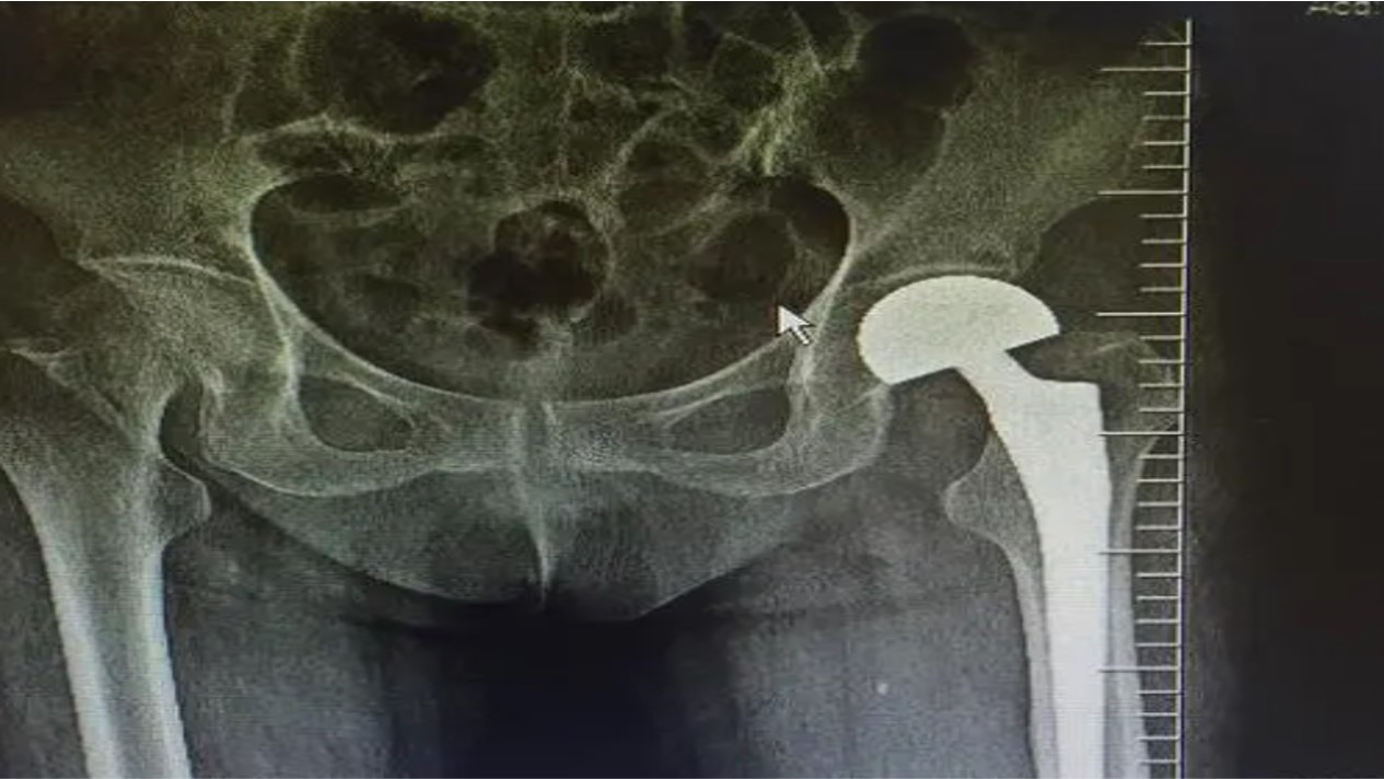 老年人腿摔骨折吃什么恢复快,老年人摔倒骨折的最佳治疗方法