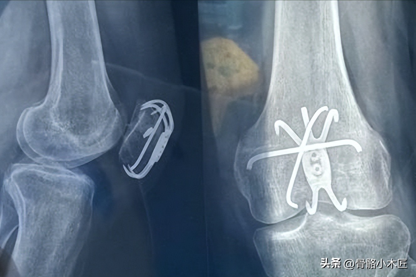 髌骨骨折二次手术取钢丝痛苦吗,髌骨骨折取钢钉手术完多久能走