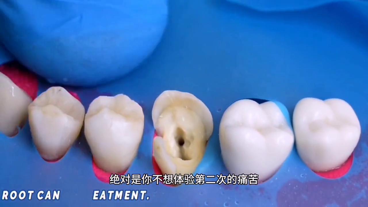 补牙神器补牙缝的视频全过程,真实补牙视频全过程