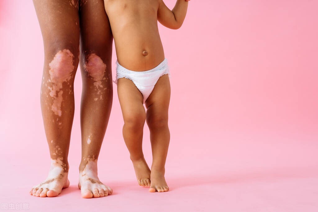 额头上长白斑是怎么回事,额头白斑最快恢复方法