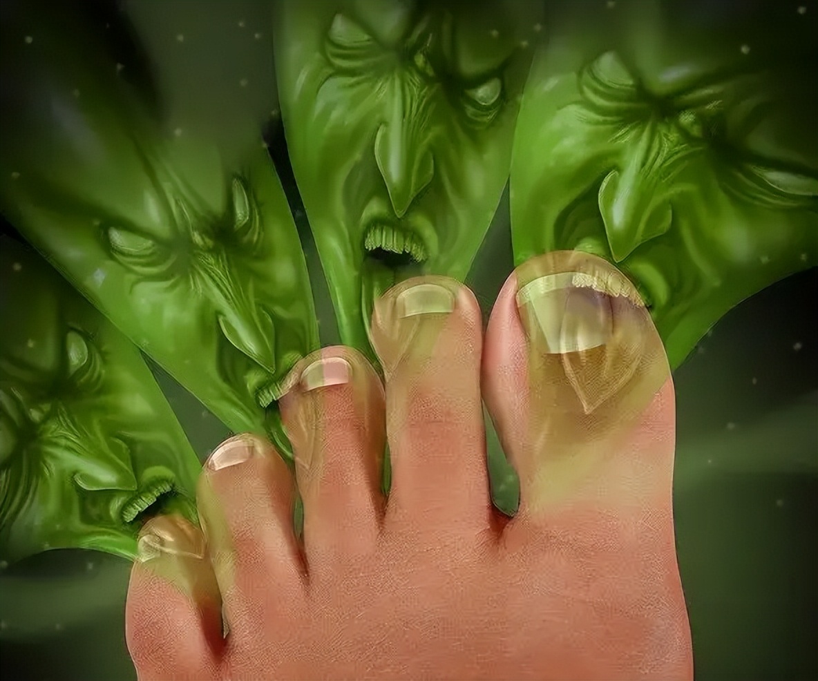 引起灰指甲的主要原因是,引起灰指甲的原因中医