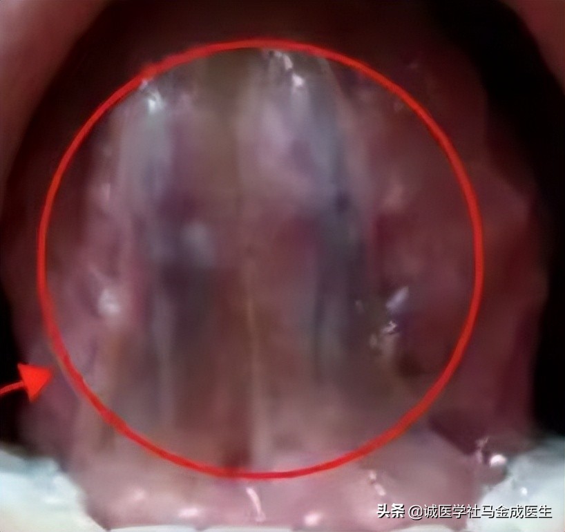 舌暗紫体内有淤血吃什么中药,舌下瘀血吃什么中药化瘀