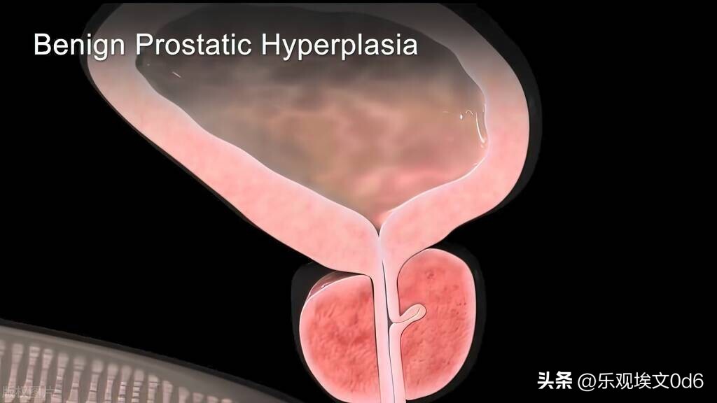 老年人前列腺增生吃什么中成药,老年人前列腺问题有什么大的危害