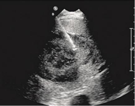 介入穿刺全过程,介入穿刺技术