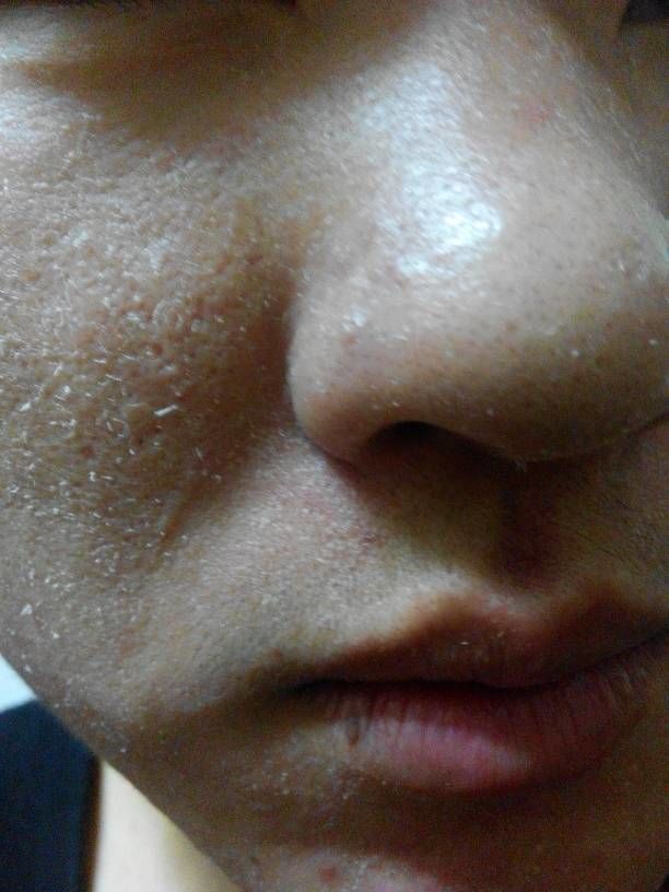脸上起皮了是怎么回事,脸上起皮是什么原因怎么办