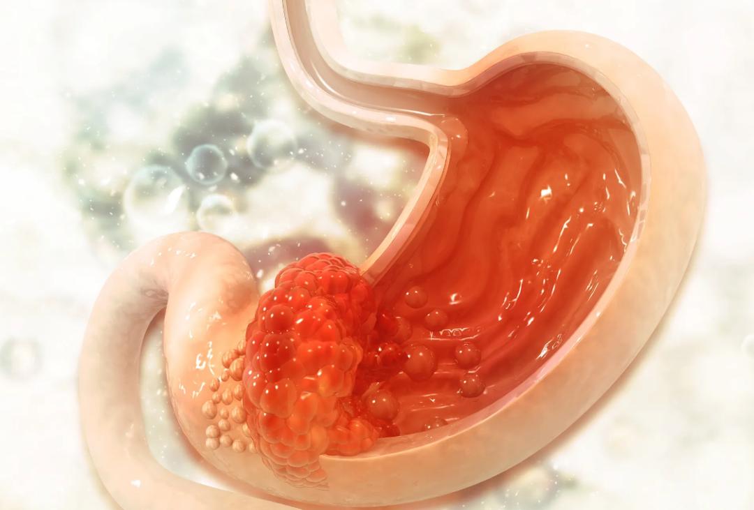 体检发现有息肉，离癌症还有多远？我彻底方了...