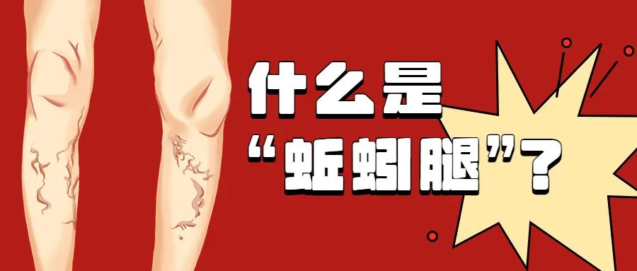 跷二郎腿静脉曲张怎么治,静脉曲张跷二郎腿有好处吗