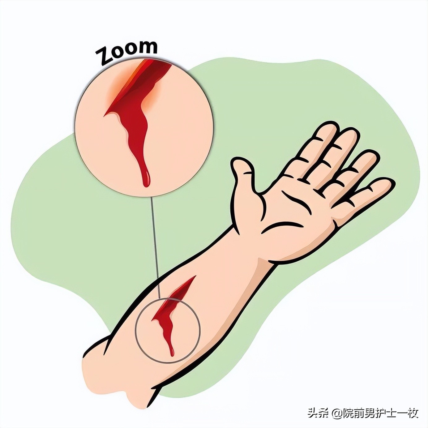 破伤风预防相关知识和图片,破伤风专家问答