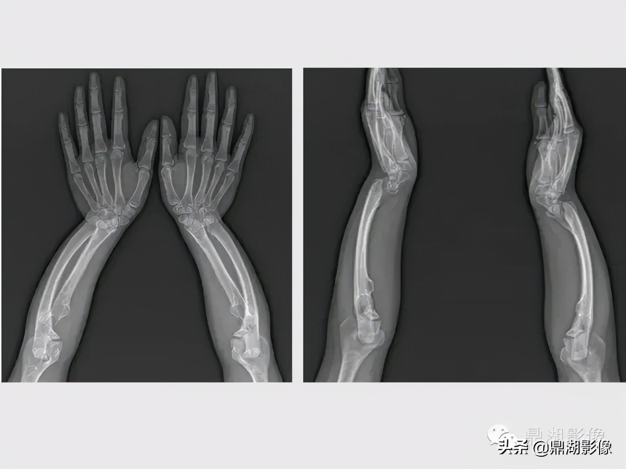 先天桡骨缺失畸形能治疗吗,先天性桡骨发育不良