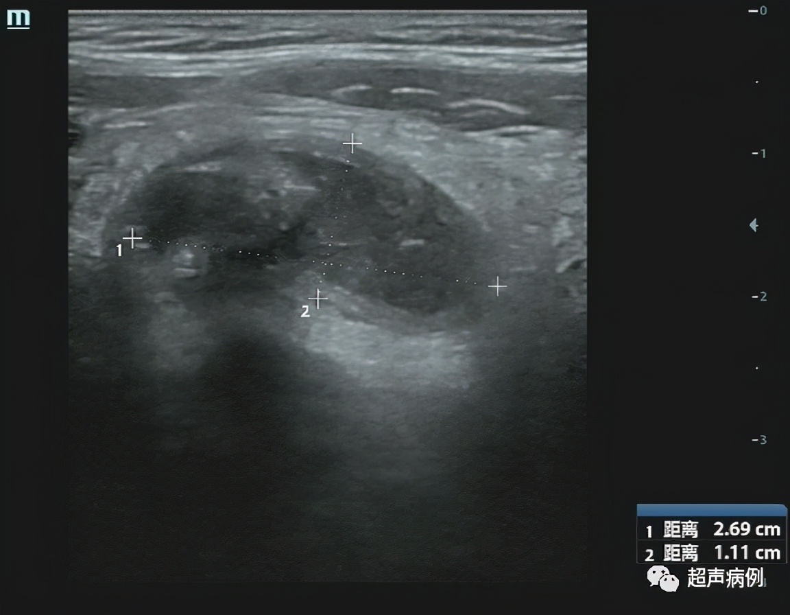 阑尾炎超声下怎么看？哪些知识需要掌握？这里都总结好了