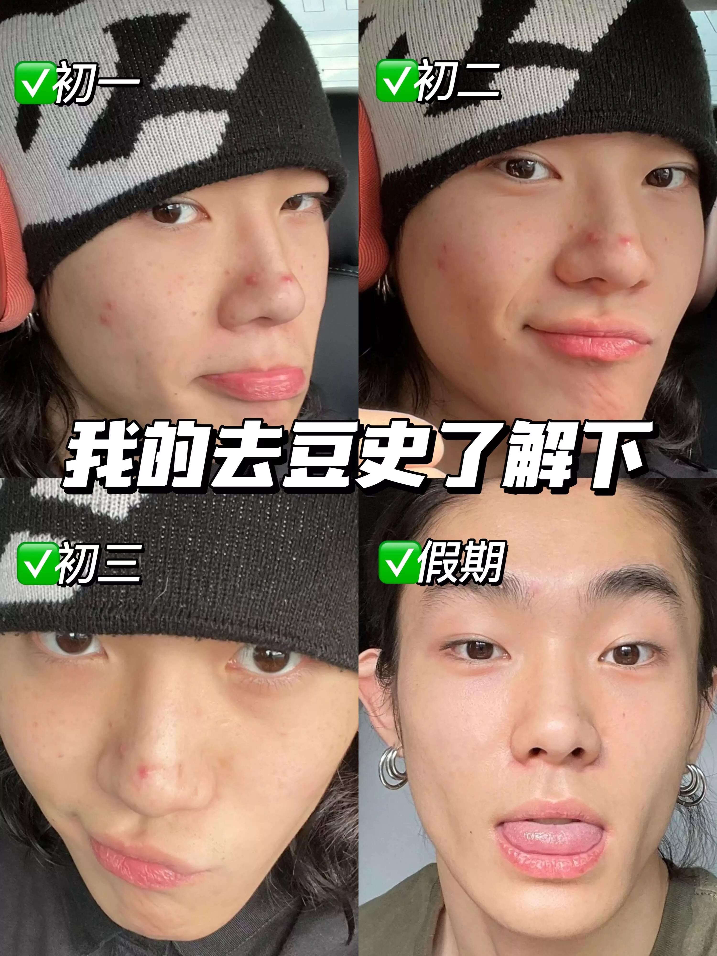 就离谱，这面霜去豆保湿太快了吧！豆子脸上岸！