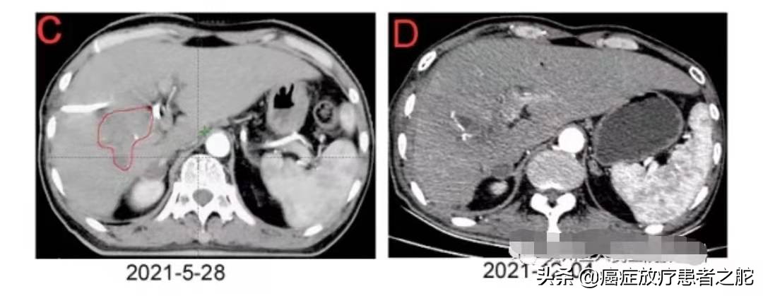 巨块型肝癌没有转移可以治愈吗,巨块型肝癌转移肺