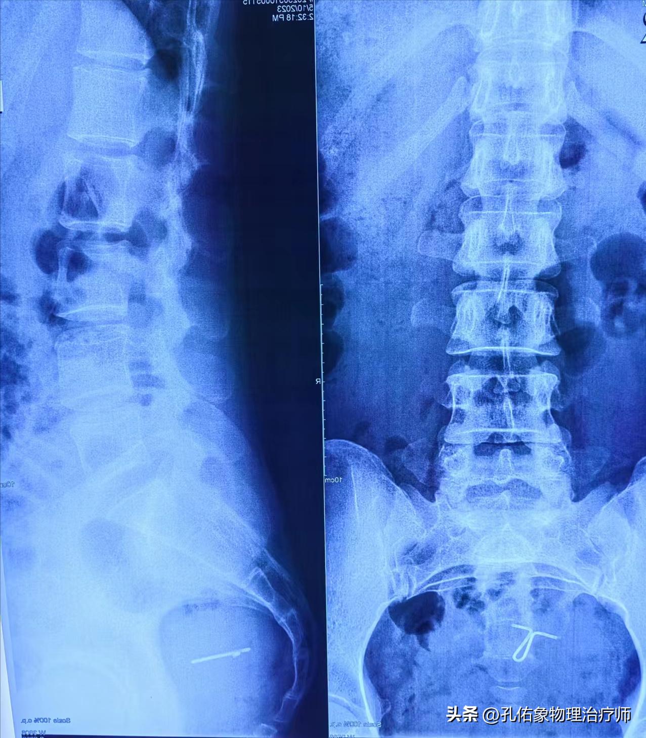 从臀部到小腿麻木疼痛怎么回事,臀部小腿酸胀是怎么回事