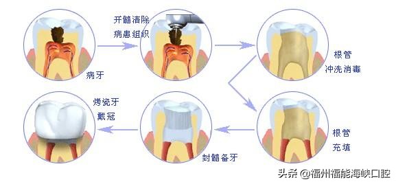 补牙太便宜怎么办,补牙太贵了怎么办