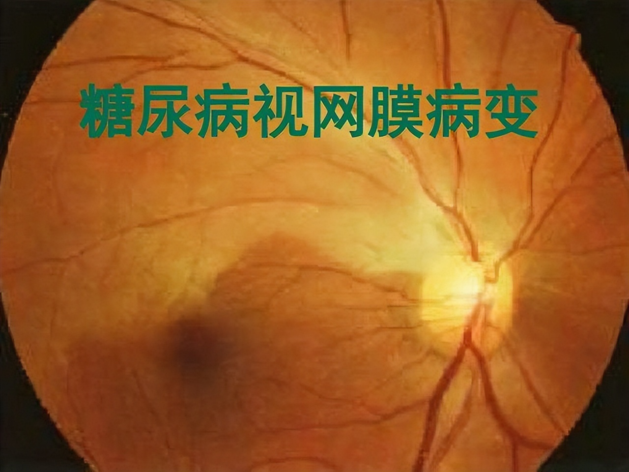 糖尿病病人可以吃羟苯磺酸钙吗,羟苯磺酸可以预防糖尿病并发症吗