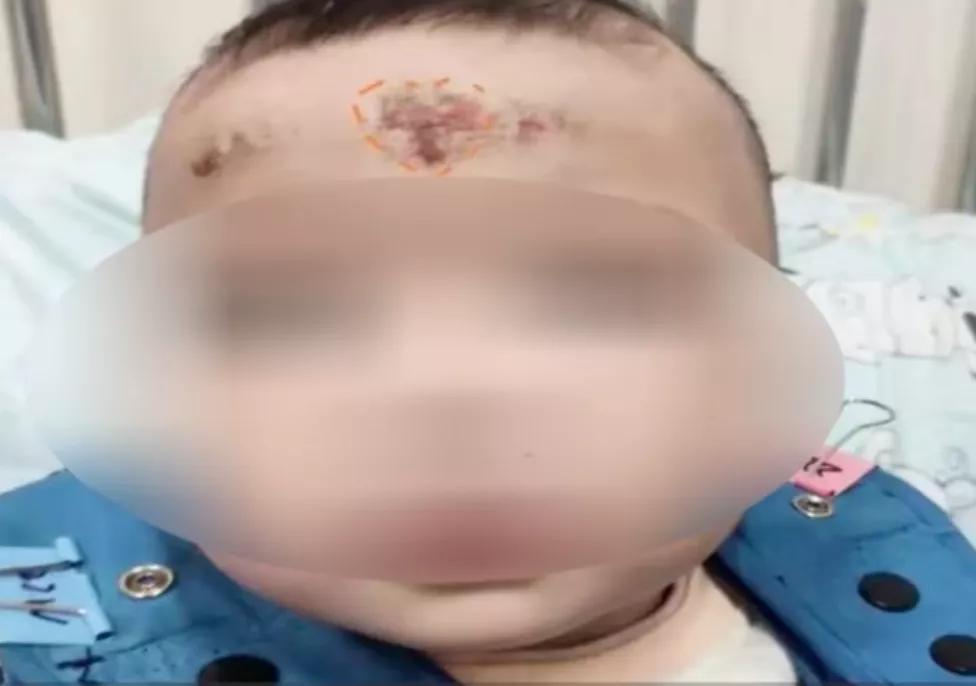 外婆给婴儿刮痧致其受伤,小儿刮痧适合哪些疾病