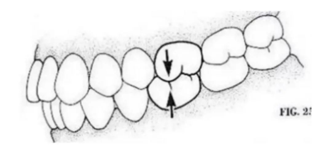 吃东西总咬腮帮肉是怎么回事,吃东西总是咬嘴看什么科