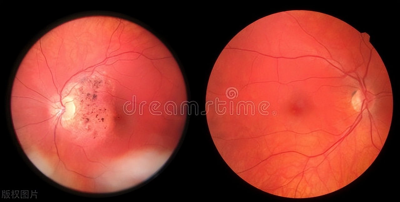 近视眼吃什么对眼睛好可以明目,吃什么食物能对眼睛近视有帮助