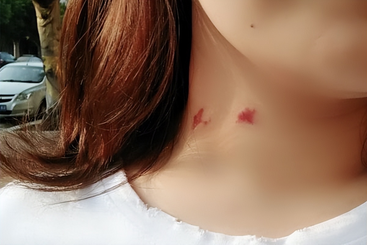 妻子和丈夫同房，被丈夫“种草莓”，第二天匆匆赶到医院，为何？