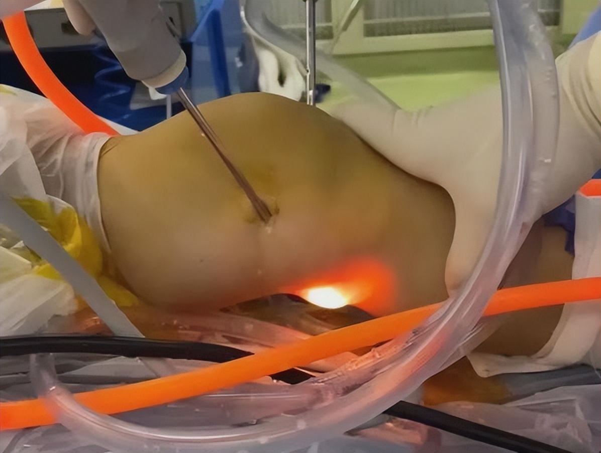 腿弯长了个包？小心是腘窝囊肿