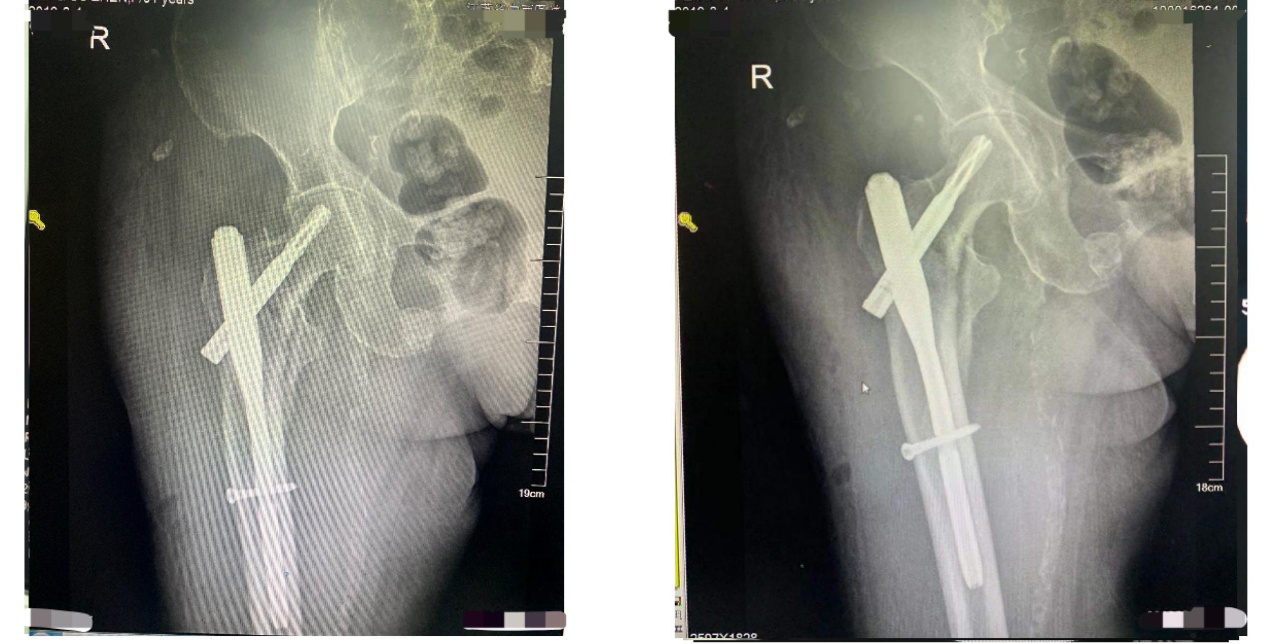 骨折后的并发症有哪些,骨折手术后需要注意哪些问题