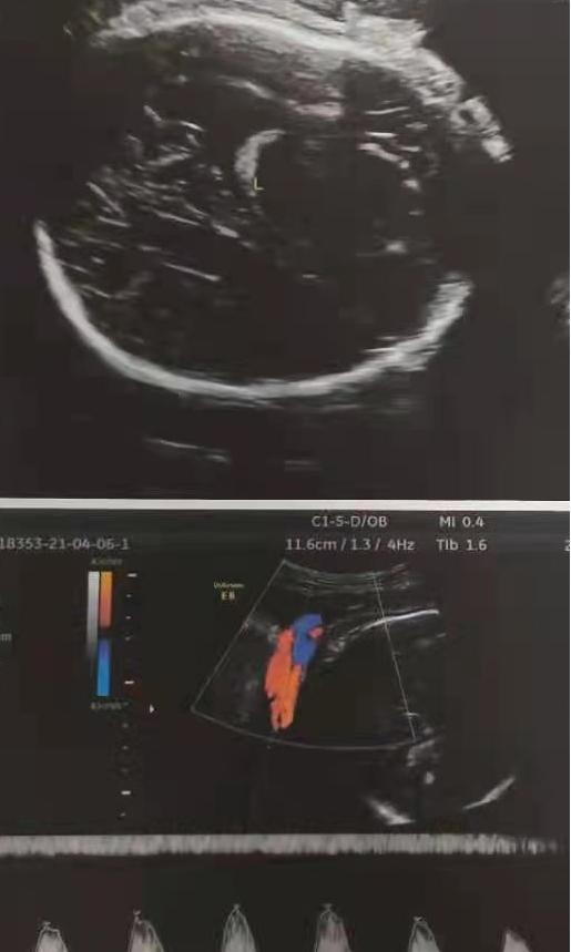脐带长度超过多少厘米容易发生绕颈？脐带绕颈的胎宝宝能出生吗？