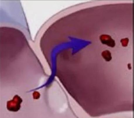 卵圆孔未闭介入封堵治疗前庭性偏头痛的疗效分析