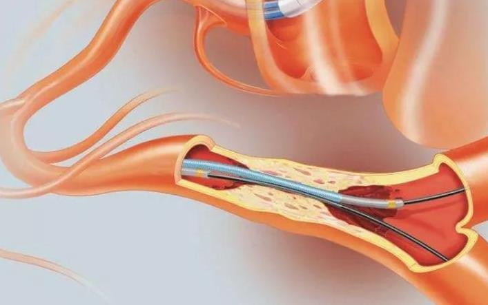 介入治疗能否疏通血管,心脑血管介入治疗最好医院