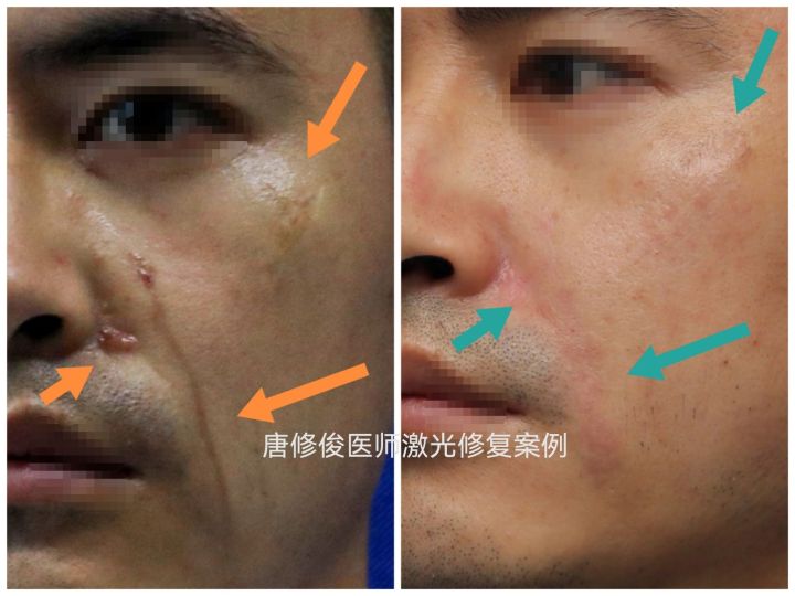 疤痕早期激光干预,疤痕激光治疗最佳方法