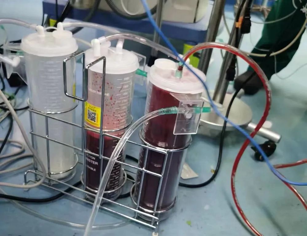 宫外孕紧急手术救人,宫外孕抢救