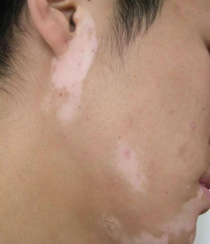 有什么白斑是不用治疗的,白斑怎样治疗才能消失呢