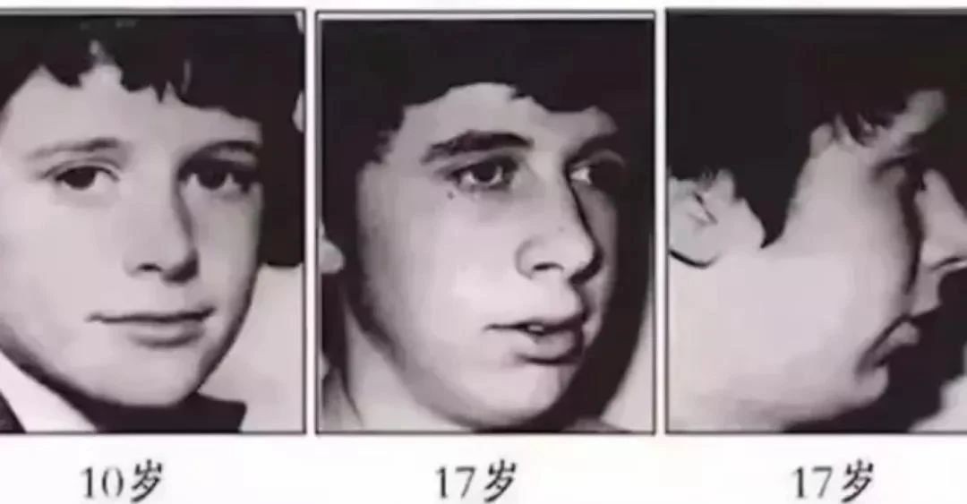 下巴短和后缩怎么变美,下巴后缩怎么矫正嘴尖