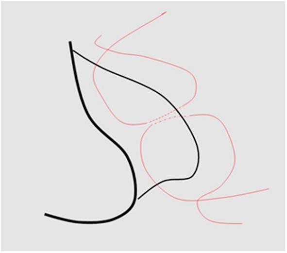 痔疮经久不愈用什么药,久痔如何治疗