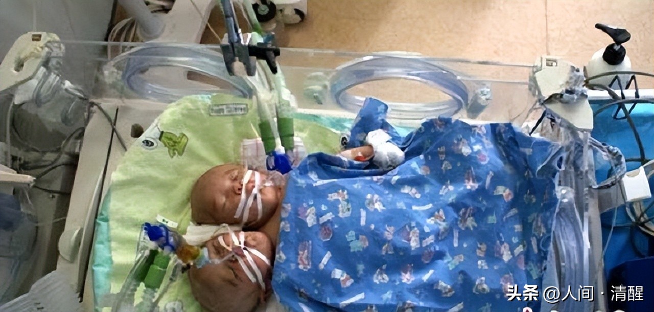 女孩去做体检发现怀了四胞胎,女子怀双胞胎竟是被遗传