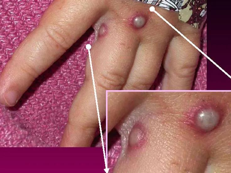 猴痘已在欧洲传播,欧美国家爆发猴痘疫情了吗