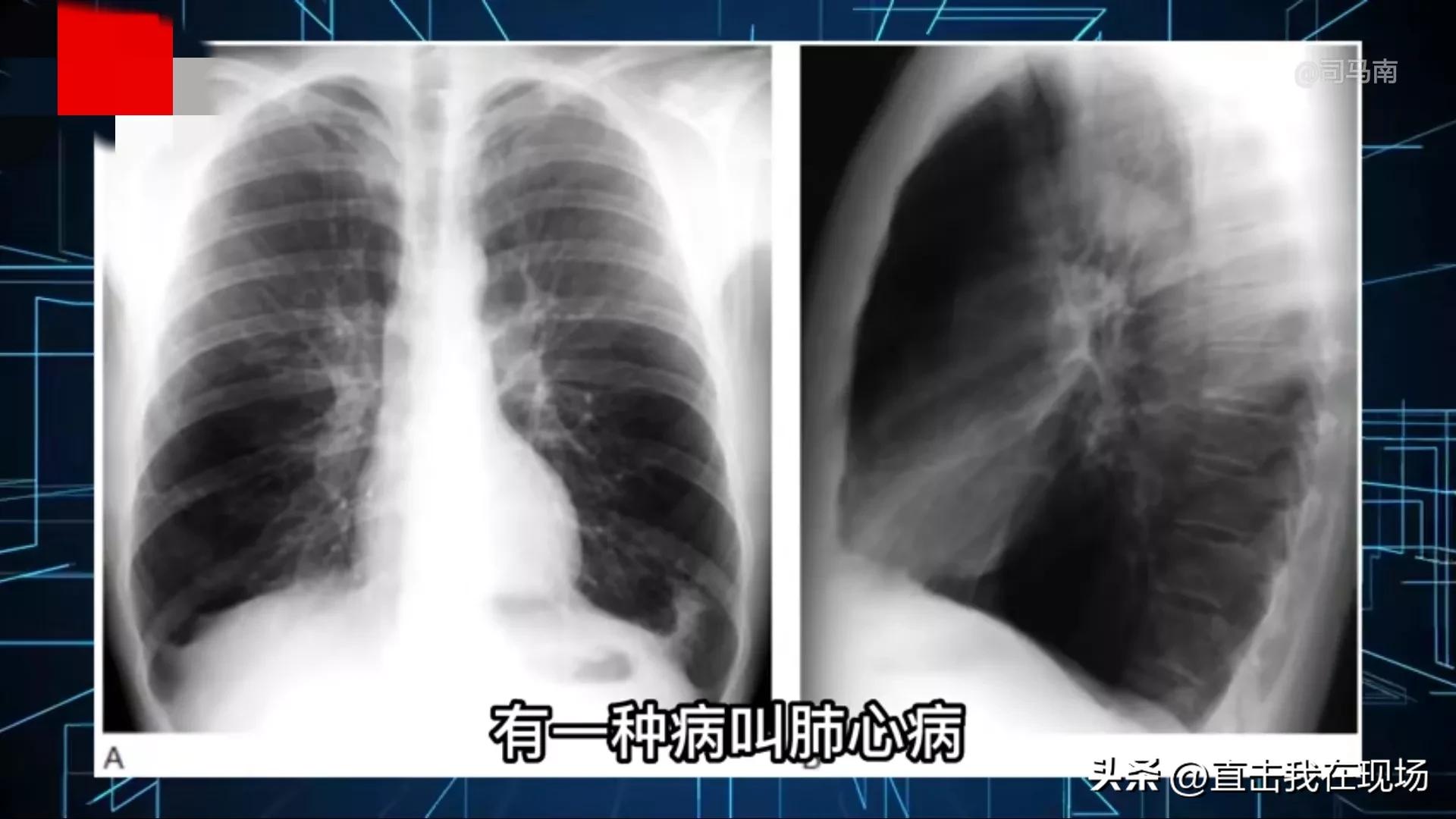 阳康后顽固性咳痰不发烧是白肺么,阳康后轻度肺气肿憋气怎么调理