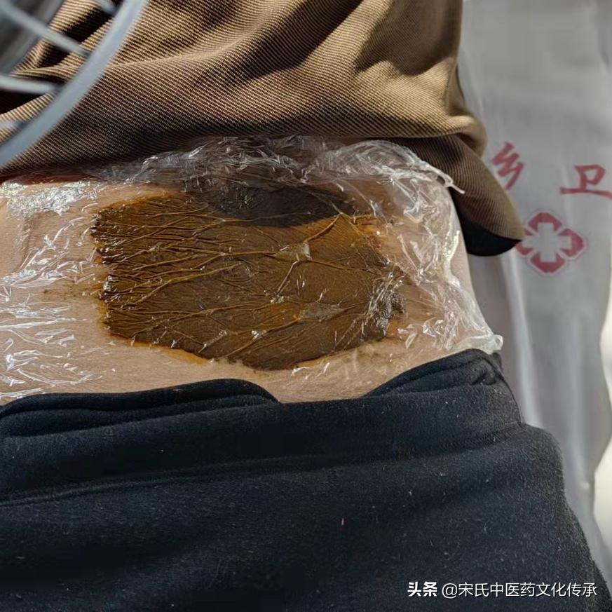 中药封包疗法-西段乡卫生院疼痛特色诊疗技术之一
