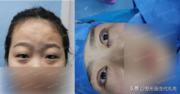 肿泡眼可以抽脂吗,有双眼皮是肿泡眼可以抽脂吗