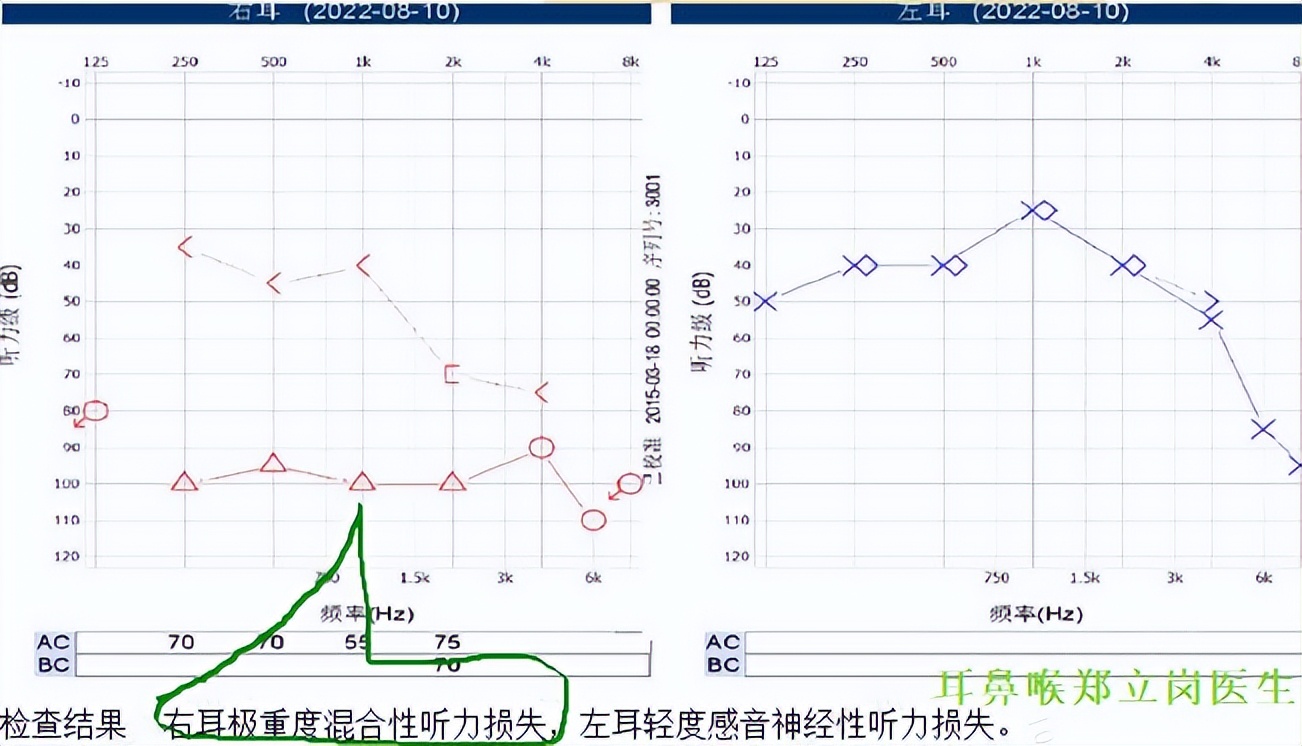 老人耳朵听力差怎么治疗,老年人耳朵流脓需要手术切除