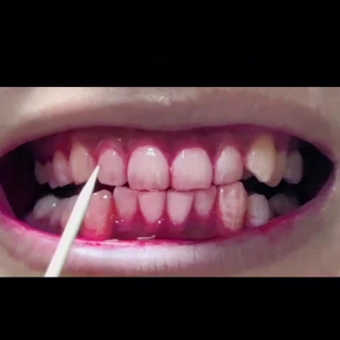 滂臭预警！牙缝抠出来的软垢到底是什么？#usmile笑容加