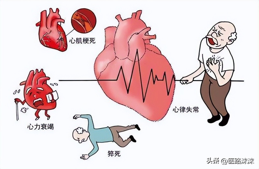 ST段抬高型心肌梗死,st段抬高型急性心肌梗死