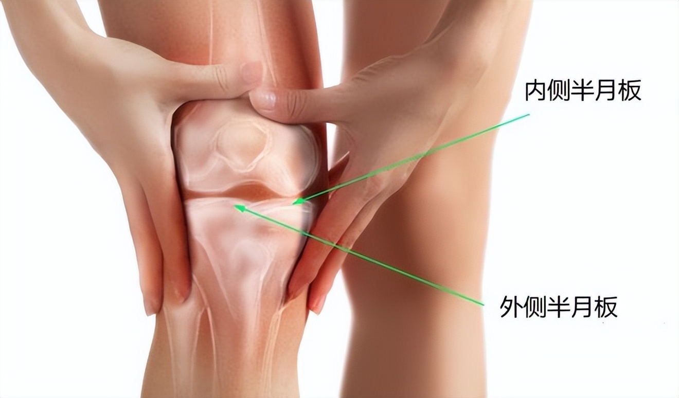 半月板撕裂恢复要几年,半月板撕裂不治的后果