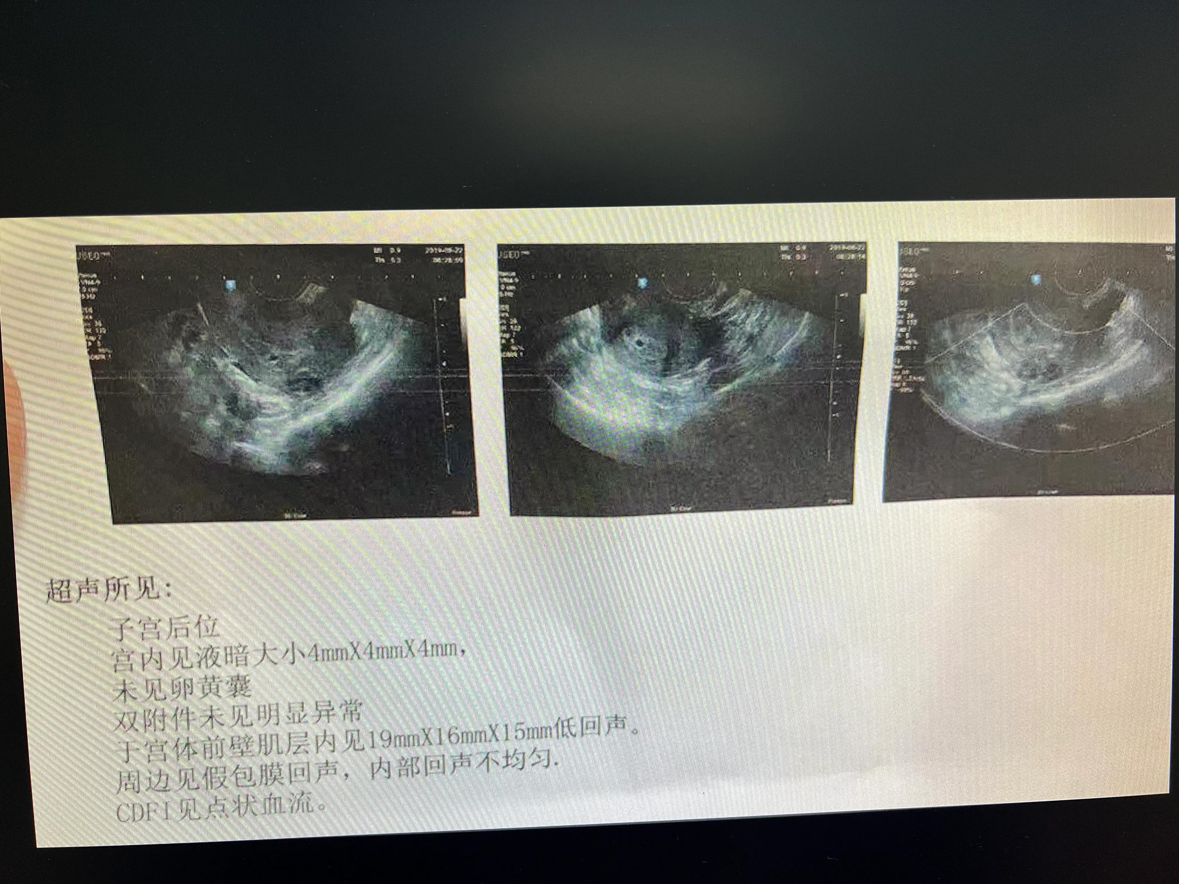 告诉老公自己怀孕了b超单,老婆怀孕的b超单